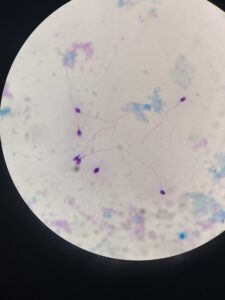 Abstinencia sexual y calidad del semen. Las imágenes muestran la morfología. Fijamos y teñimos las muestras, y utilizando un aumento mayor del microscopio (por eso se ven mejor y más grandes) podemos valorar las estructuras (cabeza, pieza media y cola) de los espermatozoides