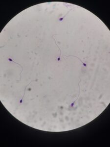 Abstinencia sexual y calidad del semen. Las imágenes muestran la morfología. Fijamos y teñimos las muestras, y utilizando un aumento mayor del microscopio (por eso se ven mejor y más grandes) podemos valorar las estructuras (cabeza, pieza media y cola) de los espermatozoides